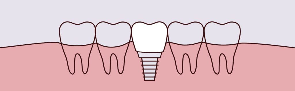 dental implants wichita