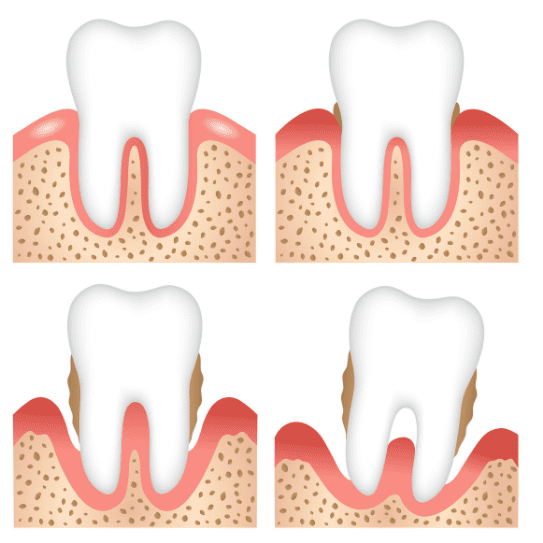 periodontal disease Wichita Kansas