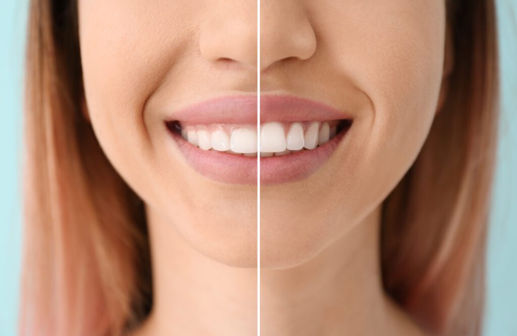 Gum Surgery in Wichita