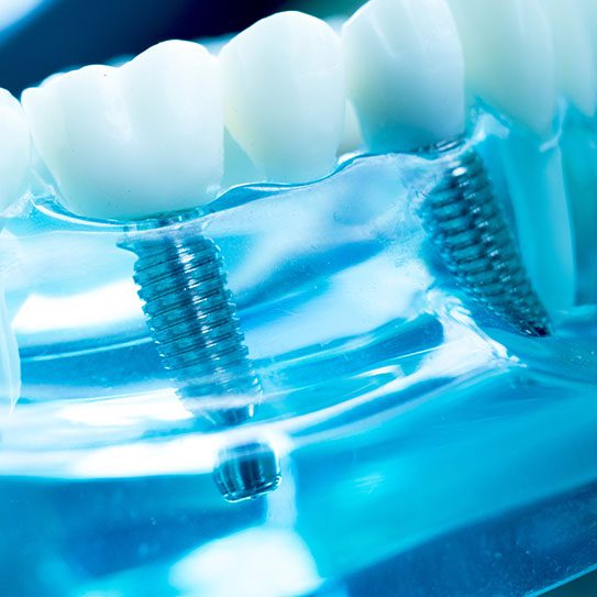 dental implants

